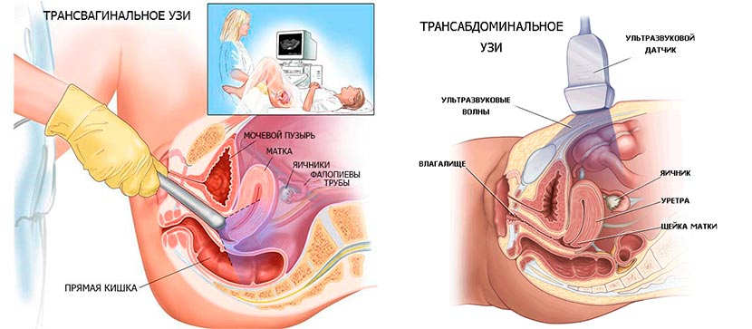 пренатальный скрининг